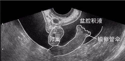 这5种所谓的＂妇科病＂,其实都不是病,别再害怕了