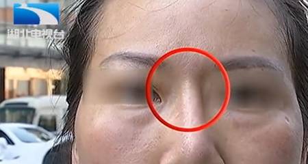 一位医疗院长表示,陈女士的鼻子变歪是术后出现骨质增生所致,属不可抗