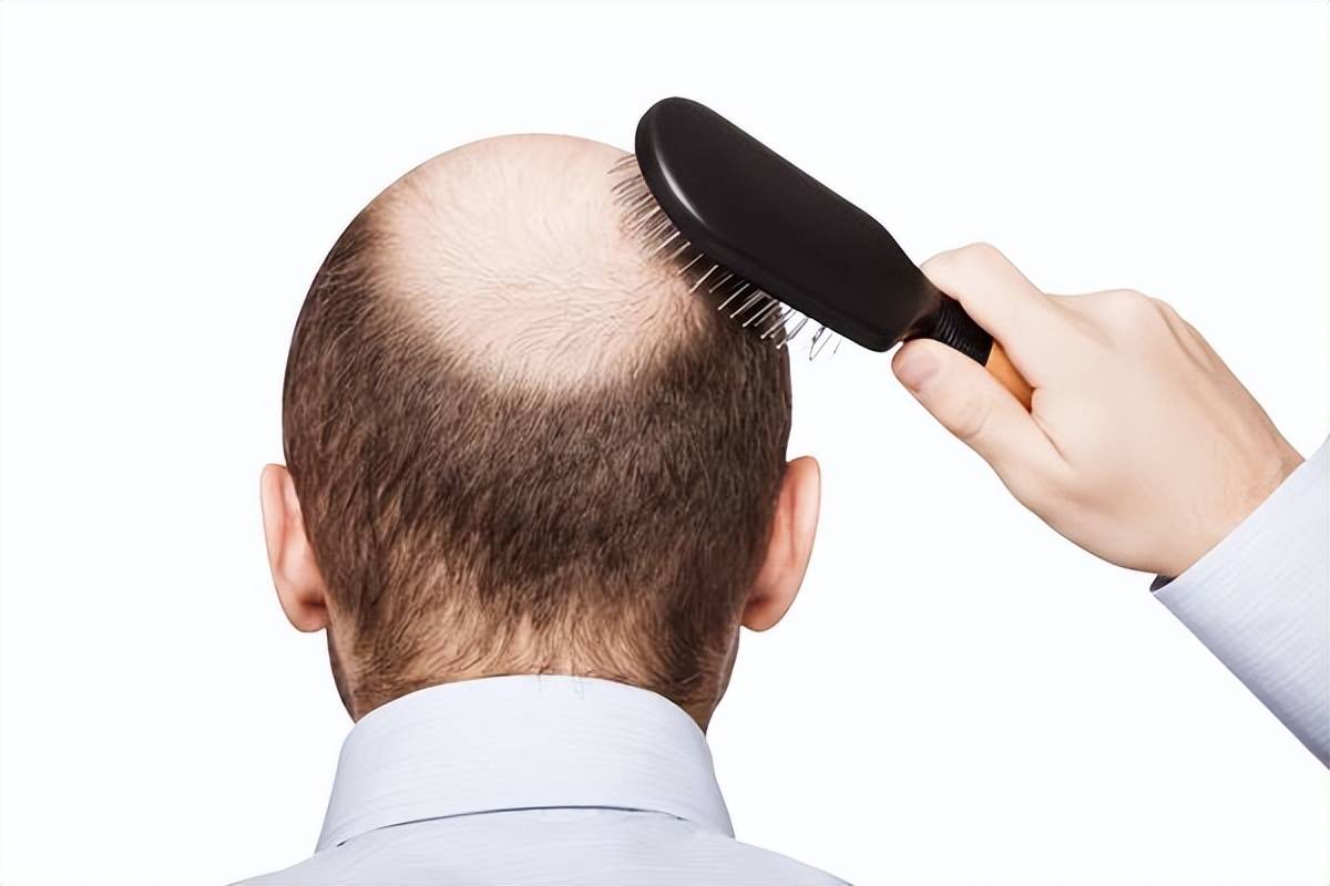 超30%阳康可能会脱发？感染新冠后为什么会脱发？