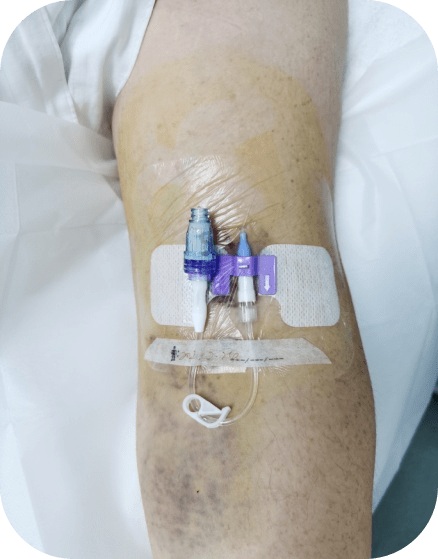 榆林市第一医院成功开展迷你中线导管技术,打开静脉治疗新篇章_患者