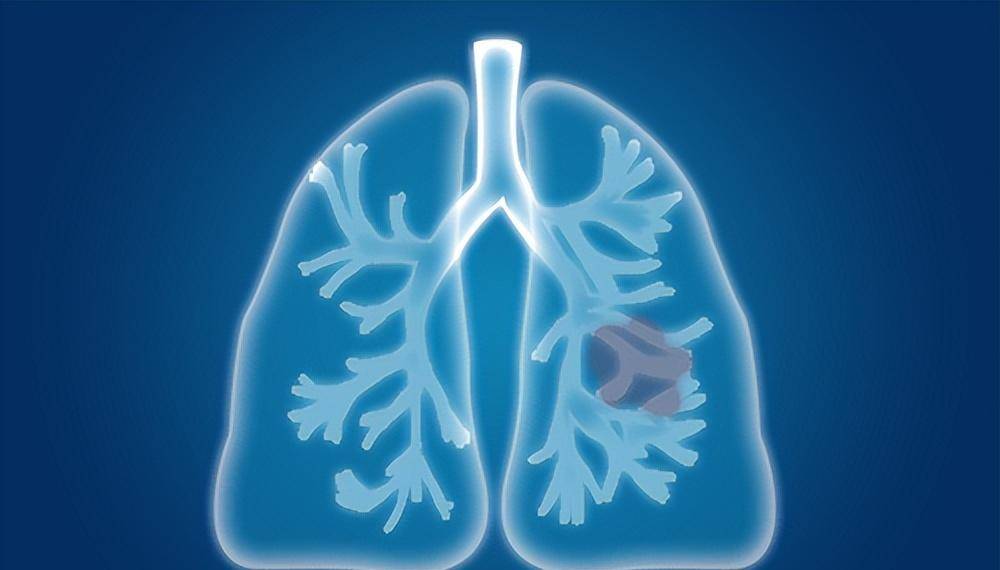 提醒:若身体出现了3个症状,建议检查_恶性肿瘤_肺部_血液