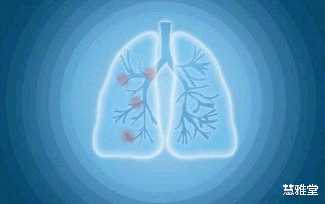 人体内只有一个肺，肺若不好，或许从4个方面能看出来，不妨对照