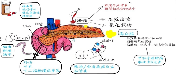 脂源性胰腺炎 来自搜狐网