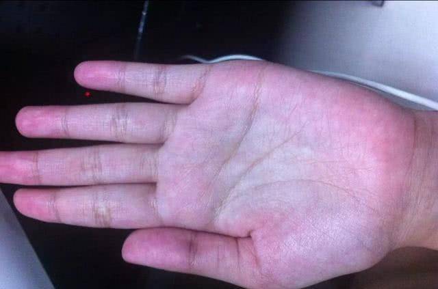 肝掌或手掌红斑是指在手掌以大,小鱼际部位皮肤广泛,强烈的泛红样改变