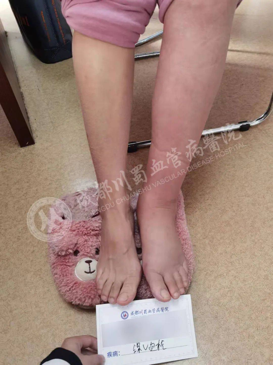 若血栓累及深静脉主干,特别是髂股静脉血栓段,可有明显的下腹部和腹股