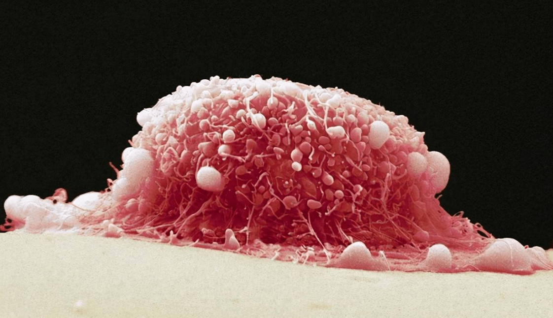 的像水一样,并且有腥臭味,晚期会出现大量米汤一样的有恶臭气味的白带