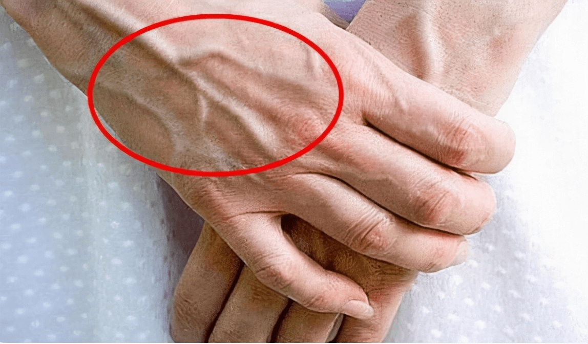 青筋暴起和看不见青筋谁更健康?_血管_静脉_王大爷