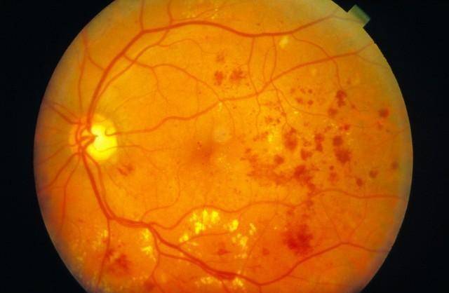 糖尿病多种并发症,根源在微循环障碍,扩张血管抗血栓