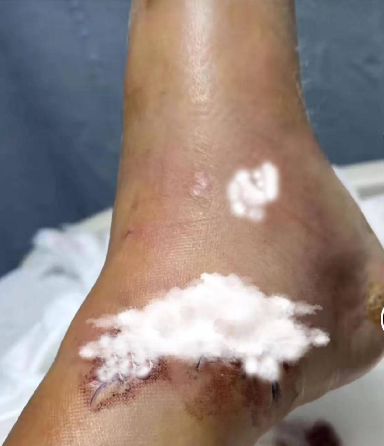 左脚受伤打钢钉,自嘲:还好脸没事_生活_明星_电影