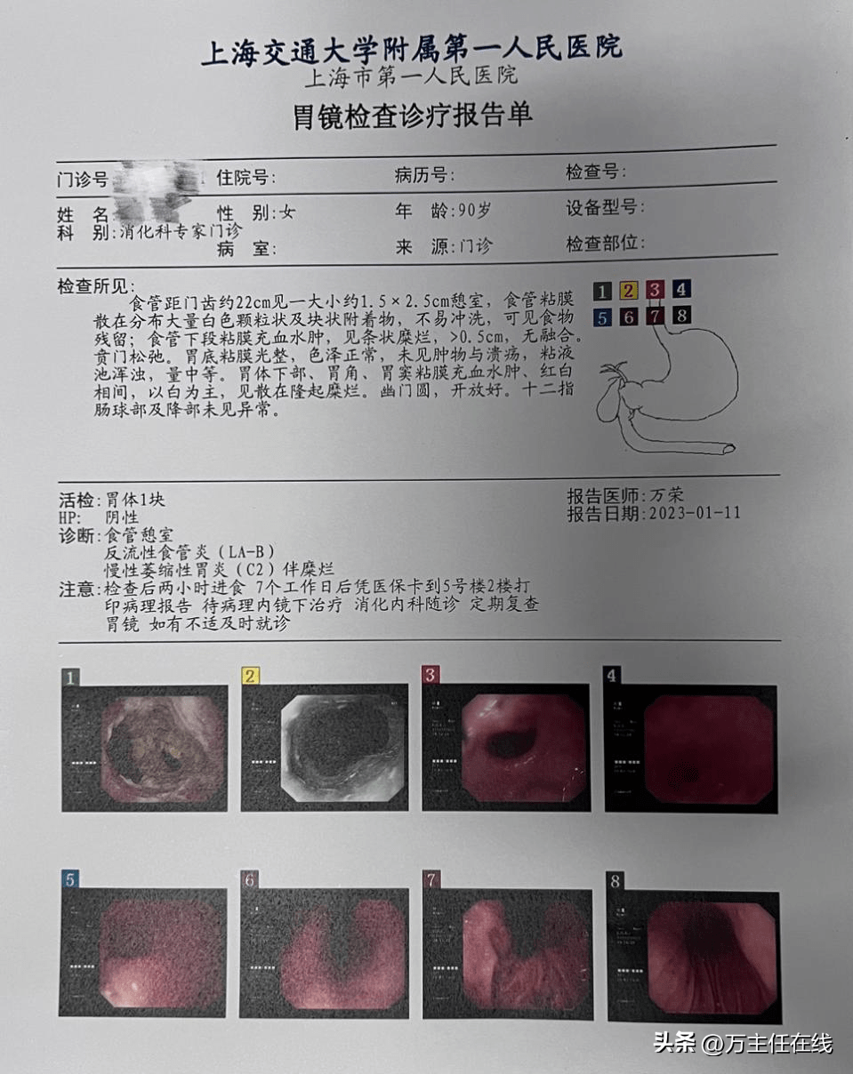 胃镜检查诊疗报告单stesd治疗食管憩室操作示例本次手术stesd操作过程