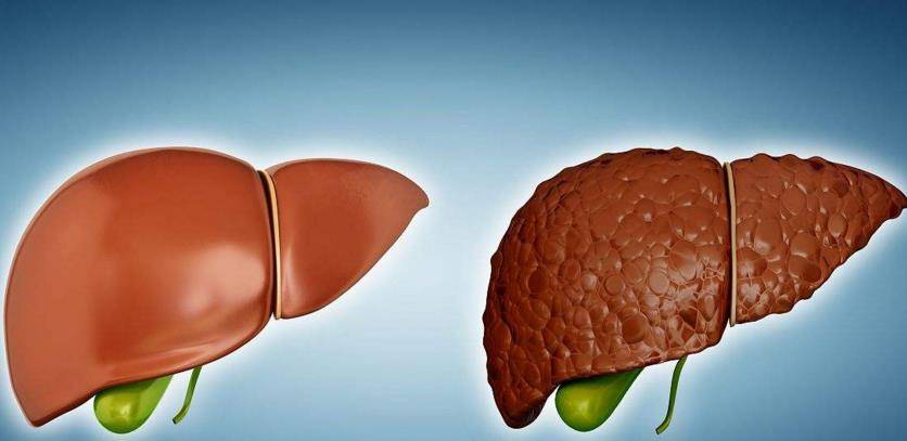 如果一个人肝脏内脂肪含量超过了5%,就会被诊断为轻度脂肪肝;如果脂肪