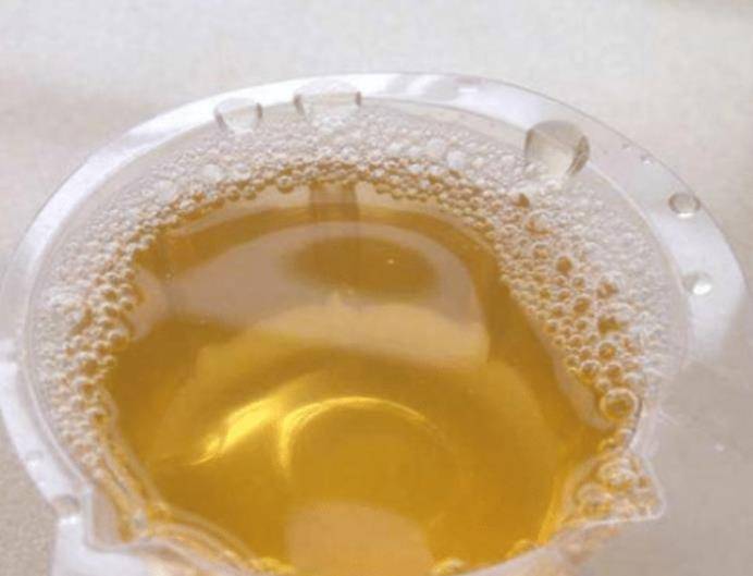 尿液发黄是很常见的,但是尿液浓黄发臭就要注意了,这很可能是由于肝脏