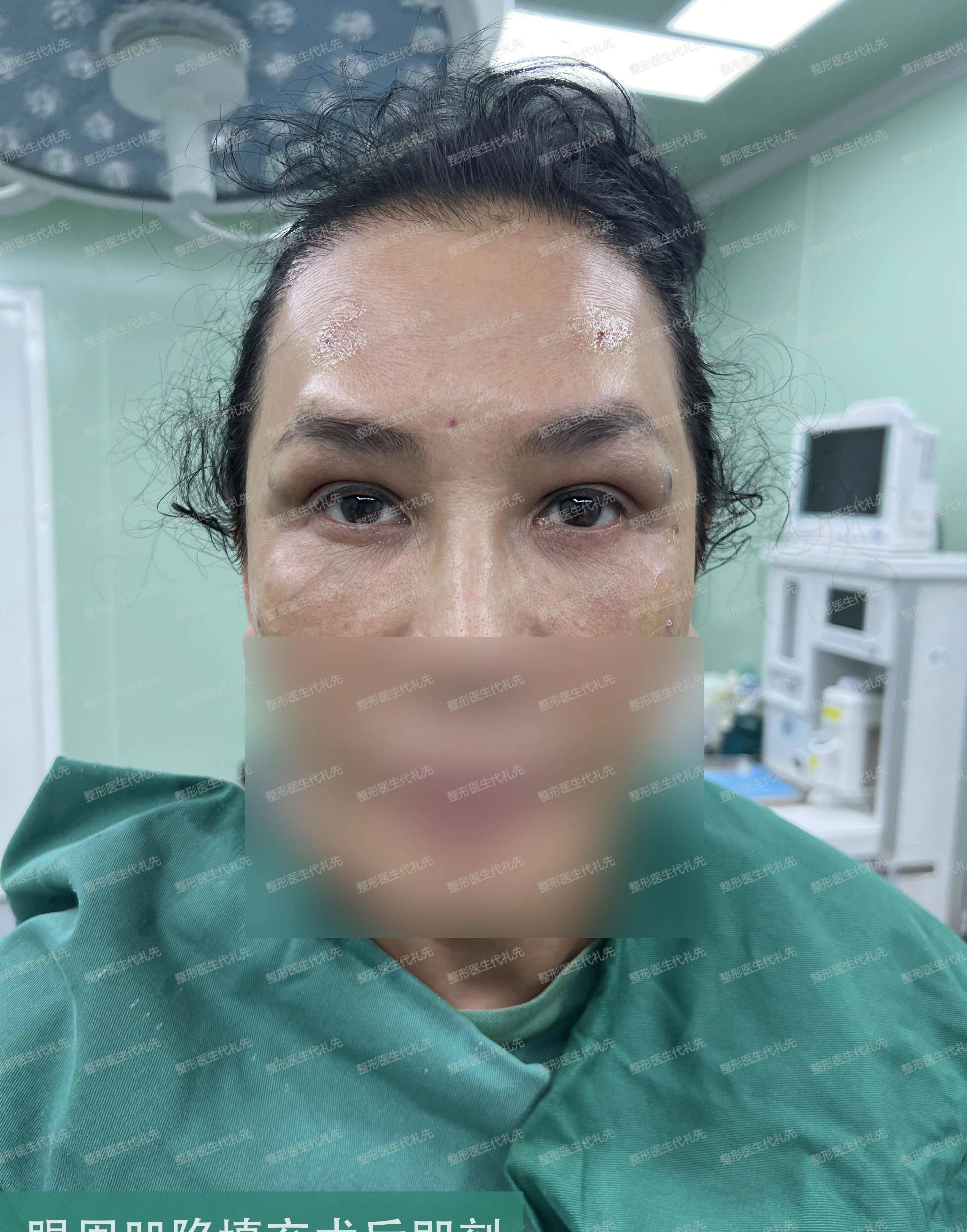 50岁北京女士不再忍受眼窝凹陷,做了脂肪胶填充,术后大变样_手术_代