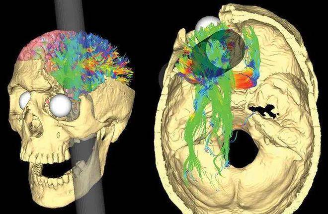 蓋奇頭骨的電腦模型展示最有可能的鐵夯穿過頭顱的軌跡(灰色部分為鐵