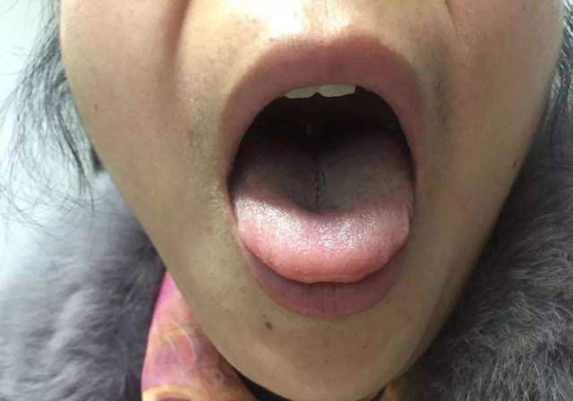 如果说动脉硬化是脑出血的一种预示,舌头发硬也有可能是脑出血的征兆.