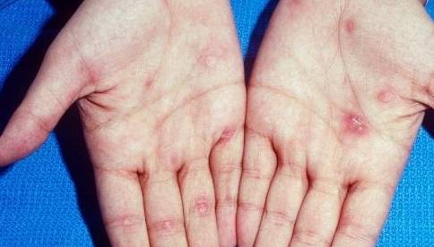 为什么患梅毒的人越来越多?会有什么症状?早知道早预防!