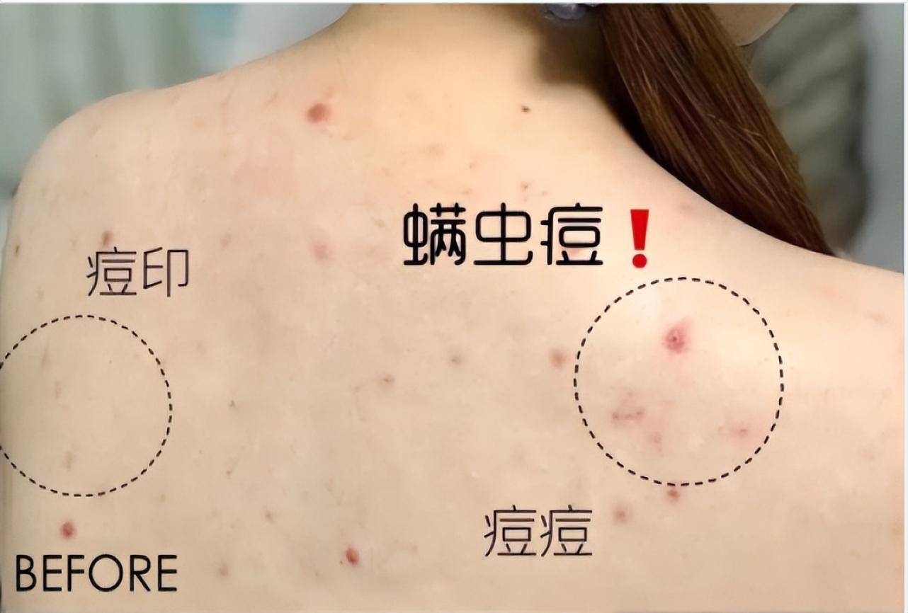洗澡时用用,红疙瘩几天就没_痘痘_时间_后背