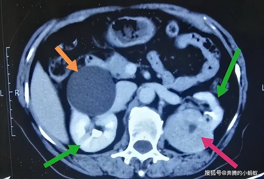 注意,男人出現這4種情況,小心是得了腎囊腫!_腎臟_手術_cm