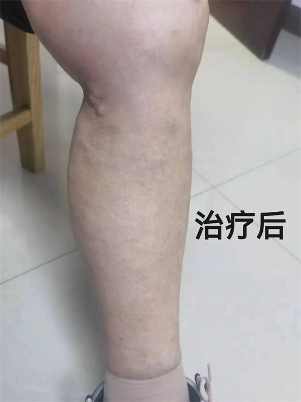 徐州市中医院治未病科:刺络放血治疗下肢静脉曲张,告别"蚯蚓腿"_患者