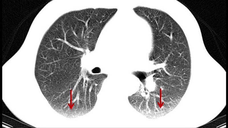 肺纹理增强图片