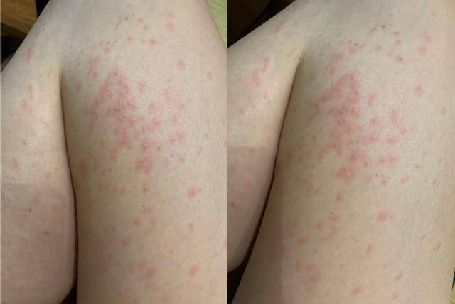 陈乔恩双腿长满红疹,凌晨发文诉苦,网友却为是不是荨麻疹吵起来