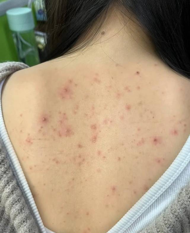 被"痘痘"毁掉的前胸后背,遇上这5招!30天用完比以前还嫩滑!