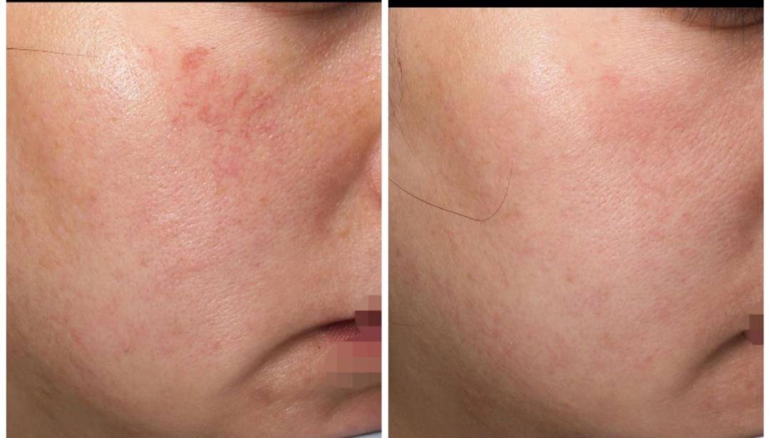 案例2案例3案例4案例5关于光子嫩肤治疗红血丝部分问题解答光子嫩肤会