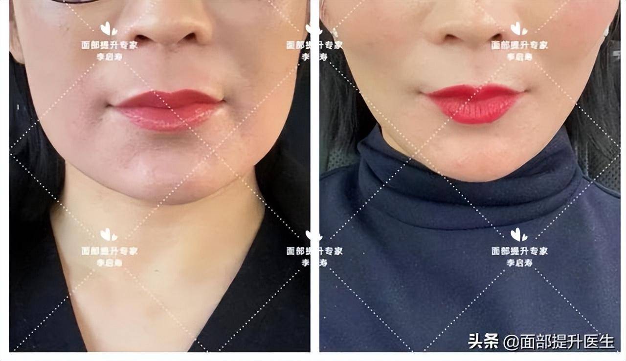 祛口角囊袋4,下颌吸脂下颌吸脂能够明显解决双下巴问题,配合口角支架