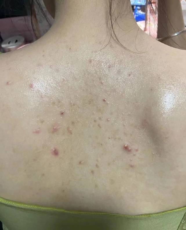 皮肤瘙痒,疙瘩这样做瞬间拥有白嫩皮肤!_后背_痘痘_时候
