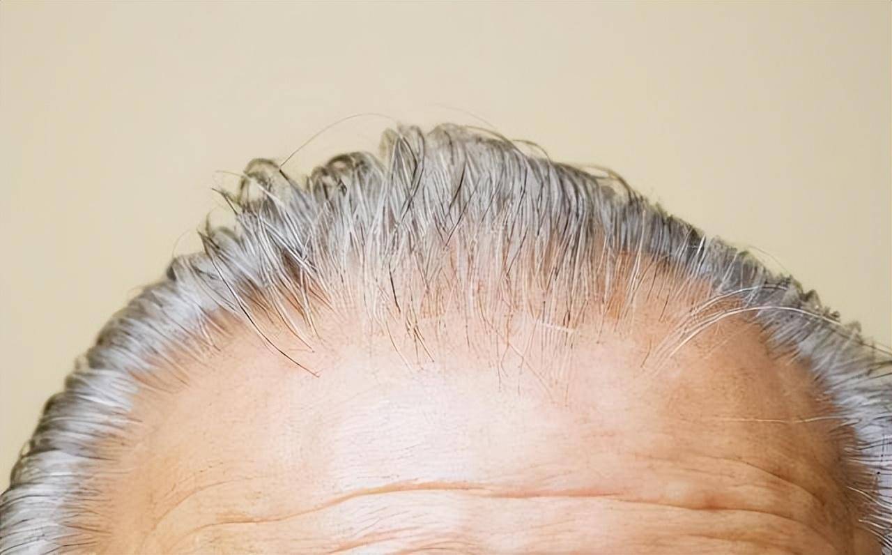 白发长在前额,两鬓,后脑勺,分别代表什么?
