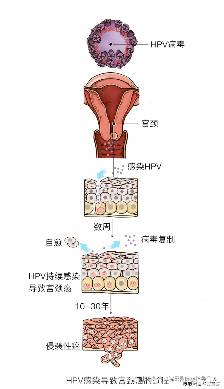 HPV感染癌变图片