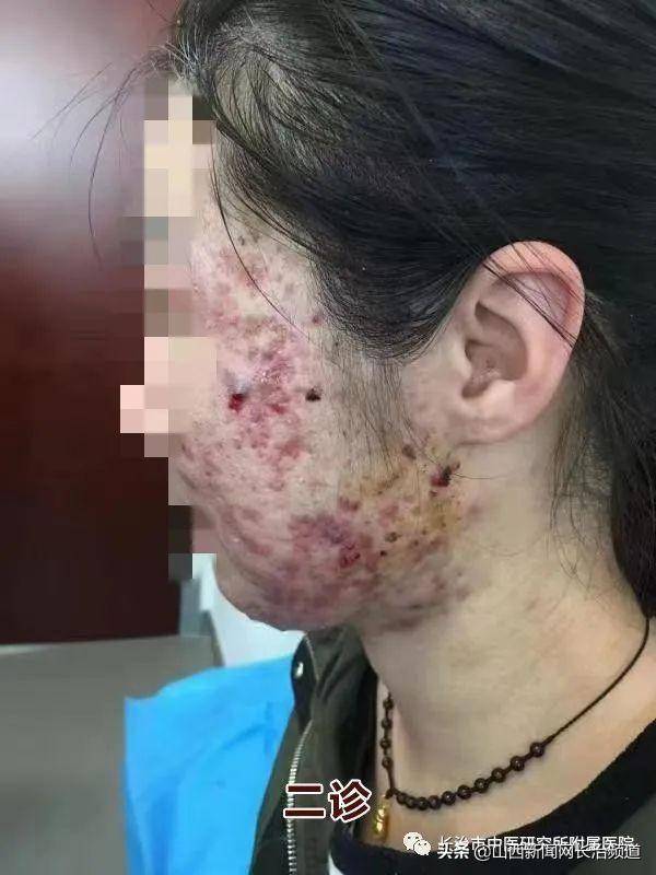 痤疮患者,皮肤科主任鲍丽丽用"火针 中药 倒模"疗法成功治疗了这位