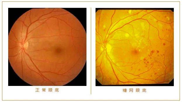 南阳南石眼科 | 糖尿病会导致失明?_病变_视网膜_患者