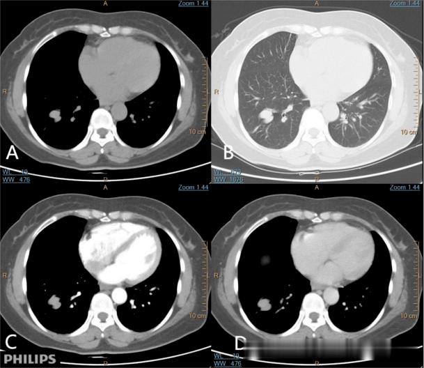 pet ct=真相!_病变_玻璃_显示