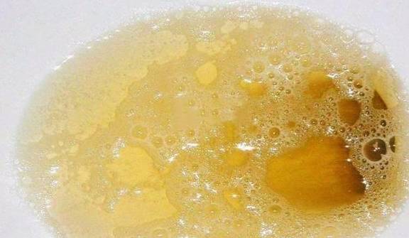 第二:晨尿发臭.