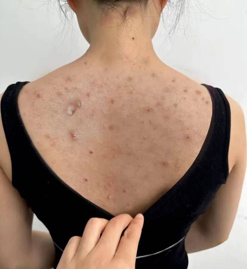 我后背长痘和大多数的人原因一样,就是平时清洁没有做到位,螨虫滋生