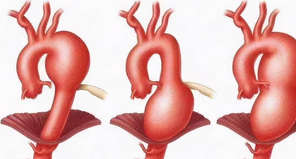 腹主动脉瘤为什么是"不定时炸弹"呢?_治疗_进行_控制