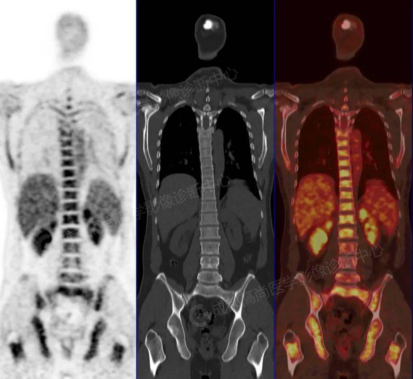 惰性b细胞淋巴瘤PET/CT诊断及疗效评估1例【成都高尚医学影像病例】_