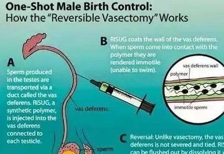 三可逆性抑精劑(risug):輸精管結紮術是指結紮和切除一小段雙側輸精管