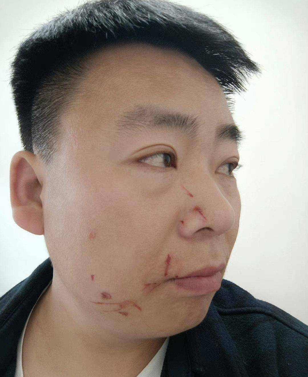 他被迪丽热巴粉丝抓伤,脸上贴了一道伤疤