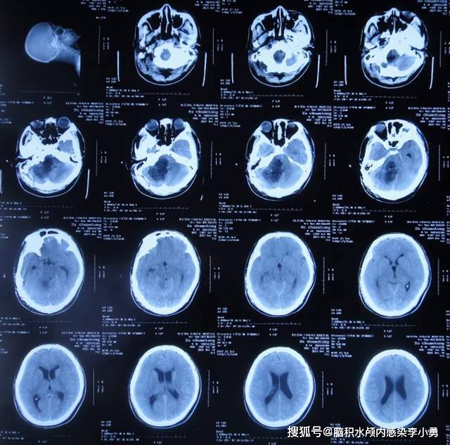 脑瘤切除术后3天即2021年12月18日,查头颅ct示小脑肿瘤切除术后状态
