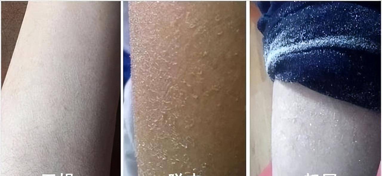 秋冬季节小腿上,胳膊上脱皮该怎么办?可以用身体乳吗?_补充_面部_成分