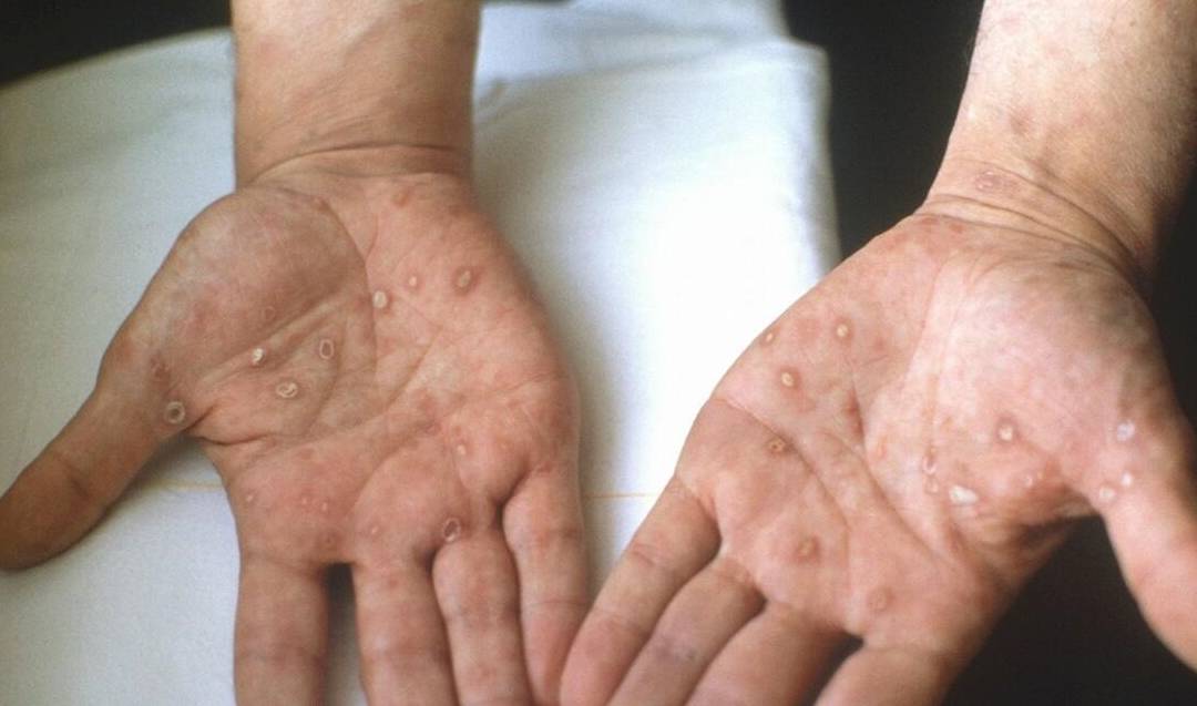 感染上梅毒第28天,如何自救,还能治愈吗?_治疗_螺旋体_病人