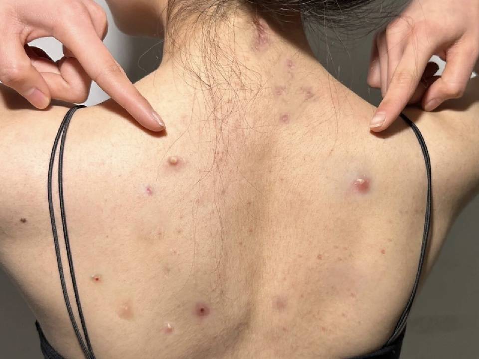 在家洗洗后背痘秒没!直接省下大几千_祛痘_效果_产品