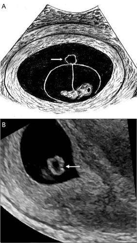 没有卵黄囊的原因怎么办?慢性子宫内膜炎可以做试管吗?