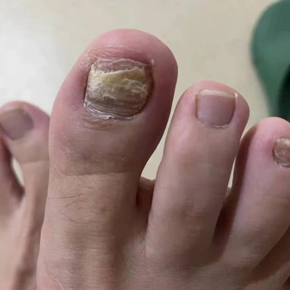 治好灰指甲真的没有这么难!学会这个方法,轻松解决5年灰指甲!