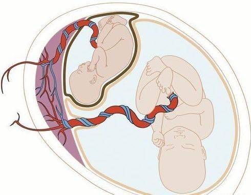 警惕一种双胎妊娠并发症