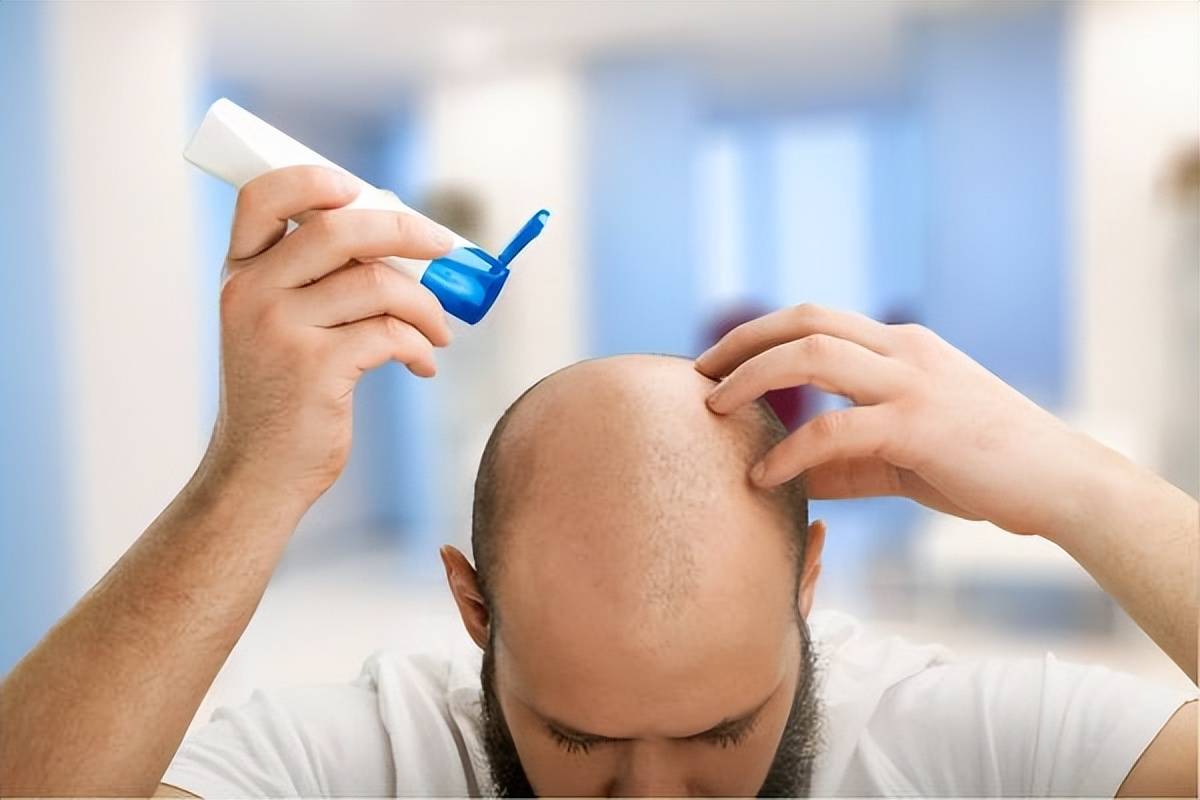 防脱发洗发水有用吗 脱发改善的4种方法
