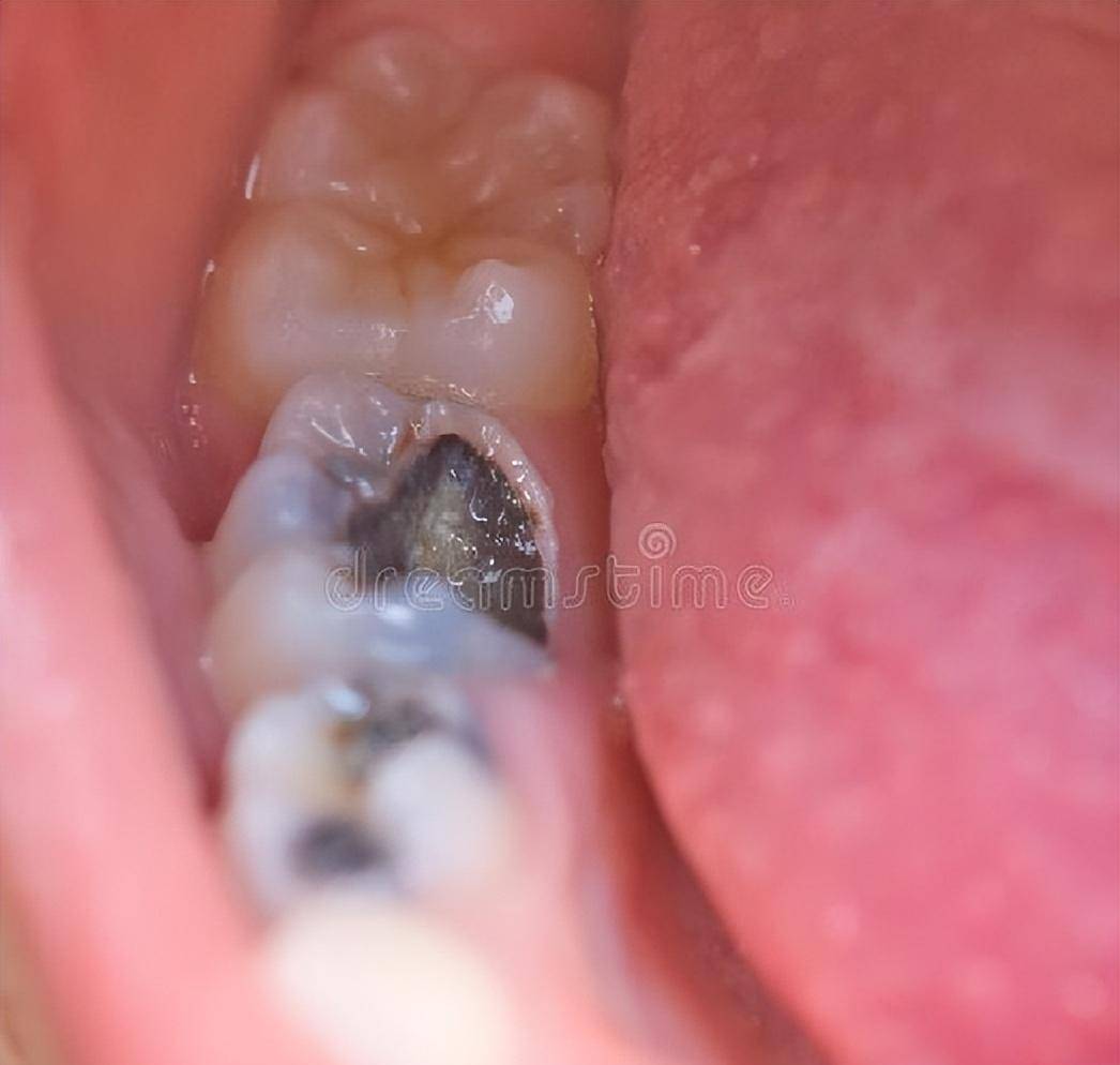 拔牙后那个洞臭到恶心怎么办一起来看看拔牙后窟窿恢复图_智齿_小时