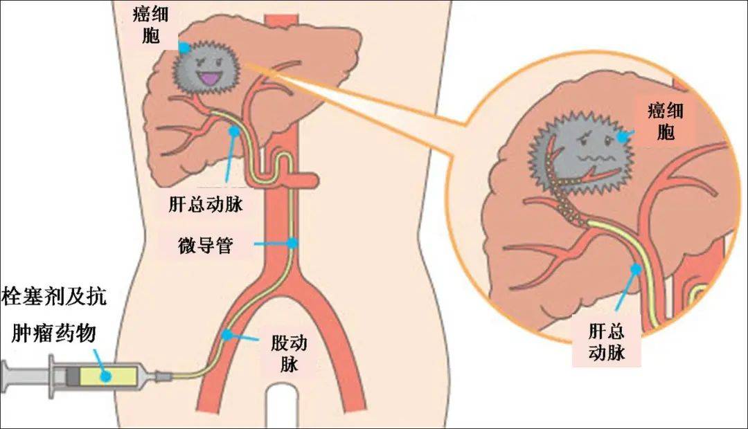 我院为肝癌患者成功实施肝动脉化疗栓塞术!